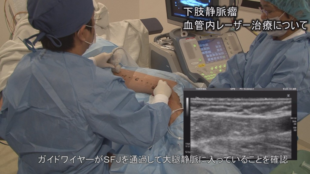 医学ビデオ制作　下肢静脈瘤血管内焼灼術実施　ビデオ解説