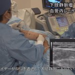 医学ビデオ制作　下肢静脈瘤血管内焼灼術実施　ビデオ解説